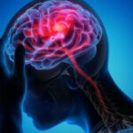 Как распознать инфаркт мозга за час до его развития