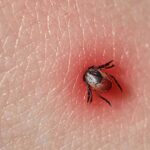 Как правильно удалить клеща: пошаговая инструкция и важные предупреждения