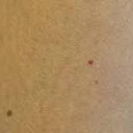 Откуда берутся коричневые пятна на коже: главные причины, тревожные признаки и что с ними делать